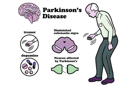 parkinson's disease review